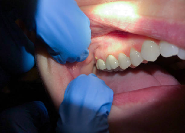 Best Emergency Dental Care for Broken or Chipped Teeth in Wartburg, TN
